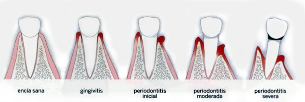 Periodoncia